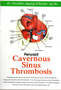 Image of Penyakit Cavernous Sinus Thrombosis